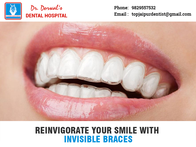 Get Invisible Braces from Elite Vaishali Dental Hospital Jaipur